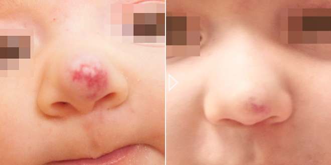 Tratamiento de lesiones vasculares pediátricas