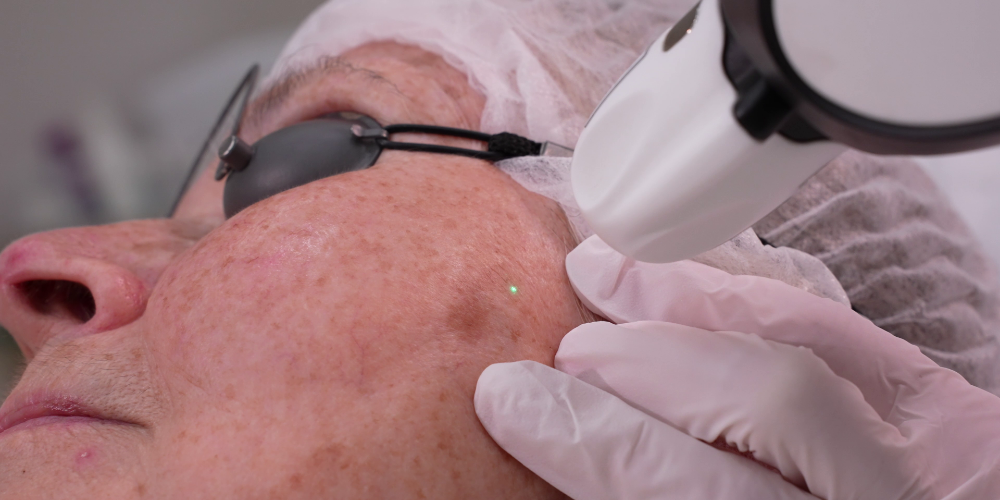 Tratamiento de lesiones pigmentadas (Pinpoint Coagulation™)