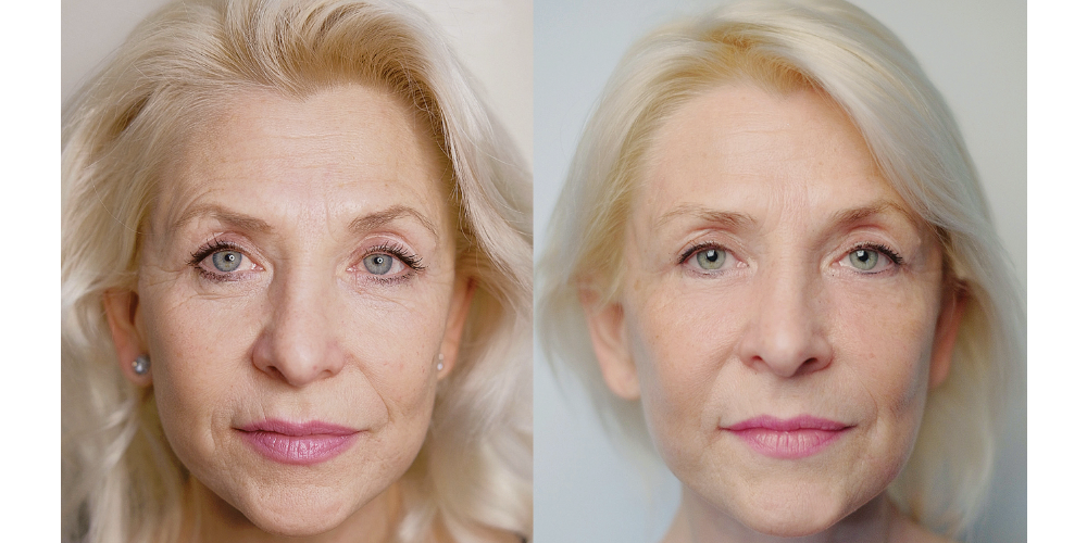 Er:YAG 2940 nm + Módulo SMA (RecoSMA®) - Emisor de ablación y regeneración