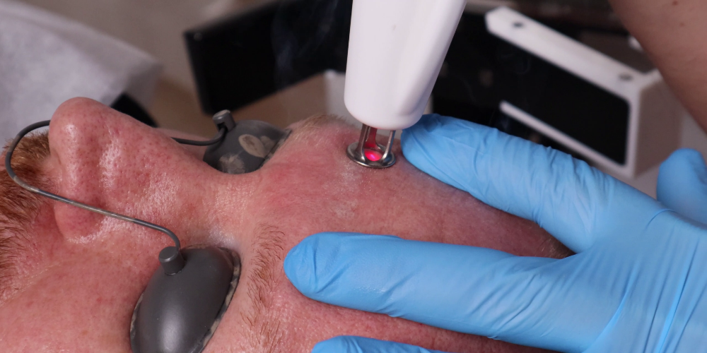 RecoSMA® - Un gran avance en la tecnología de regeneración láser