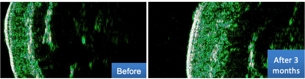 Imagen de ultrasonido DUB Cutis, 22 MHz